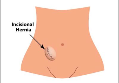 hernia